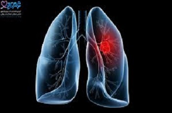 نکاتی در خصوص سرطان ریه