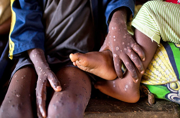 آن چه باید درباره‌ی ام‌پاکس (آبله میمون) بدانید